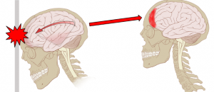 traumatismo-craniano-tipos-de-traumas-e-sequelas 